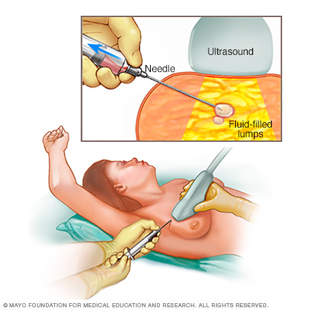 Aspirace jemnou jehlou