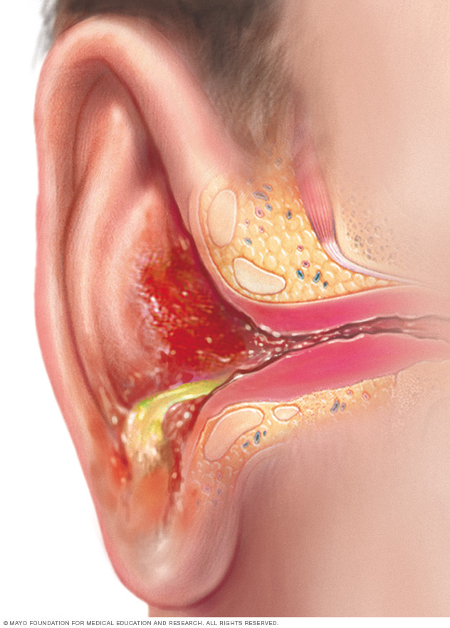 Swimmer's ear Disease Reference Guide
