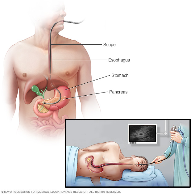 Ultrasound pankreas