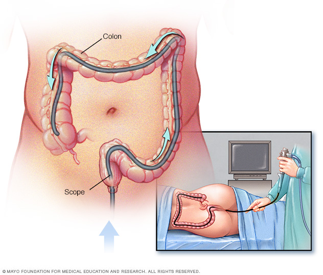 Colonoscopia