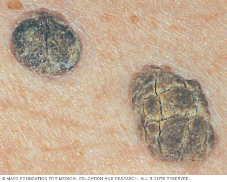 ภาพระยะใกล้ของ keratoses seborrheic