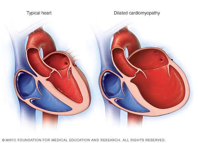 cardiomyopathy ขยาย
