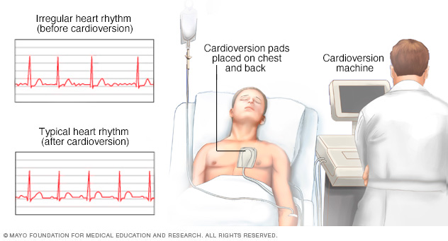 Cardioversie