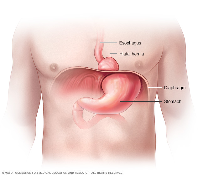 Hernia hiatal