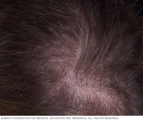 Female-pattern baldness