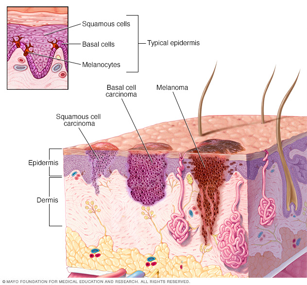 Unde se dezvoltă cancerul de piele