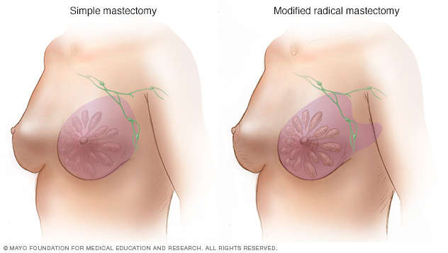 Mastectomie simplă și mastectomie radicală modificată