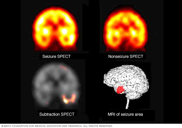 Temporal lobe seizure Disease Reference Guide - Drugs.com