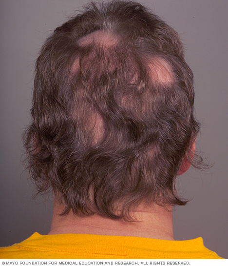 Fleckiger Haarausfall (Alopecia areata)