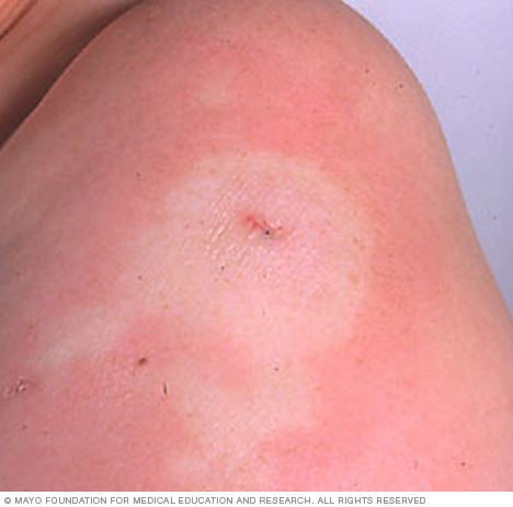 Morphea