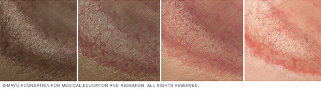 Tinea cruris: sintomi, cause e trattamento Tinea cruris: sintomi, cause e trattamento