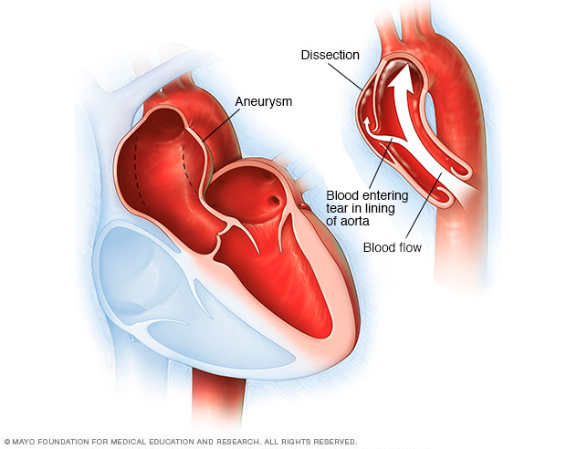 Aortan dissektio ja aortan aneurysma