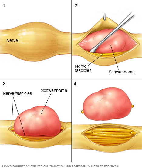 Schwannoma