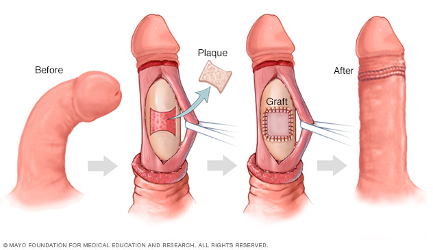 Graft repair of the penis 