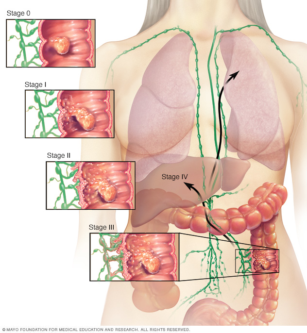 Koloncancerstadier