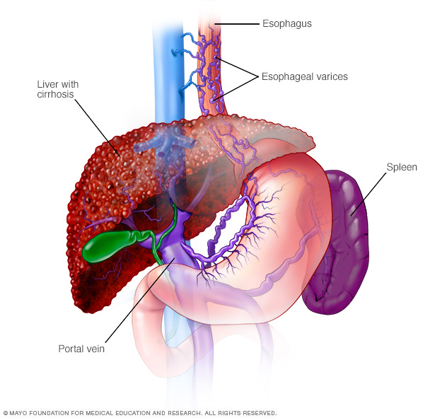 Varices oesophagiennes