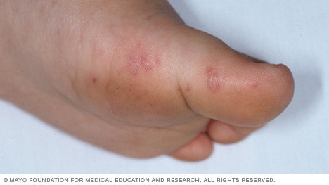 Hand-Fuß-Mund-Krankheit am Fuß