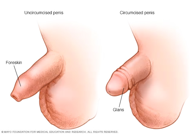 baby circumcision infection