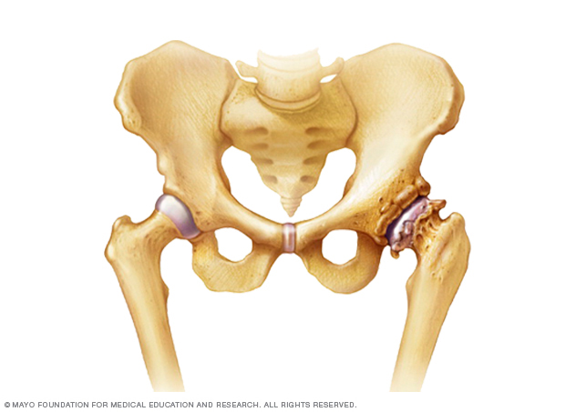 L'arthrose de la hanche
