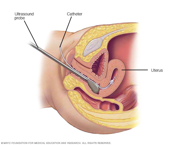 Hysterosonografie