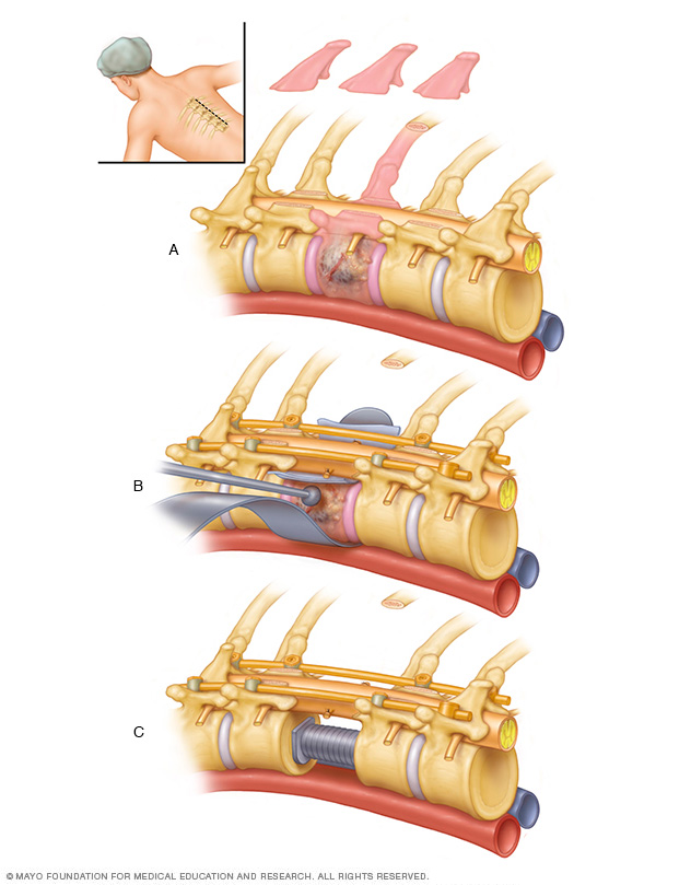 Ablation et reconstruction chirurgicales des tumeurs vertébrales