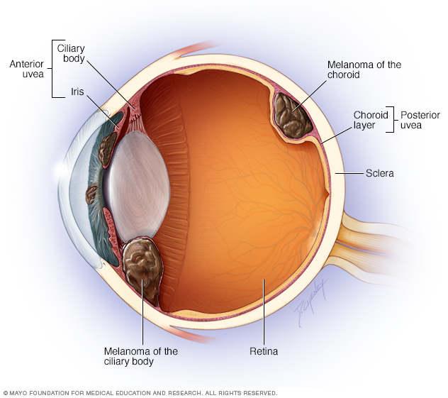 Melanom ocular