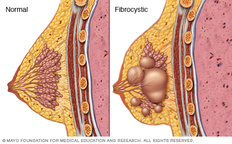 การเปลี่ยนแปลงของเต้านม Fibrocystic