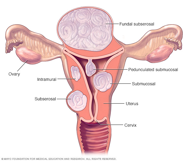 Livmorfibroider: årsak, symptomer og diagnose