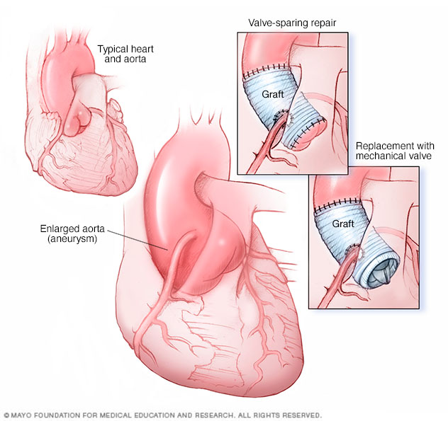 Prosedyre for aneurisme med stigende aortarot