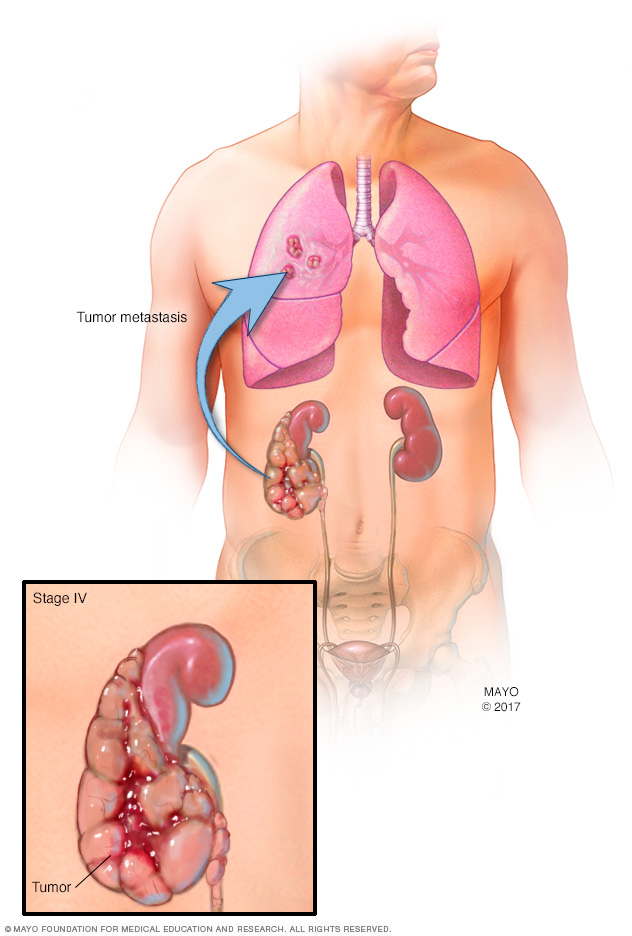 Tumor de riñón en estadio IV