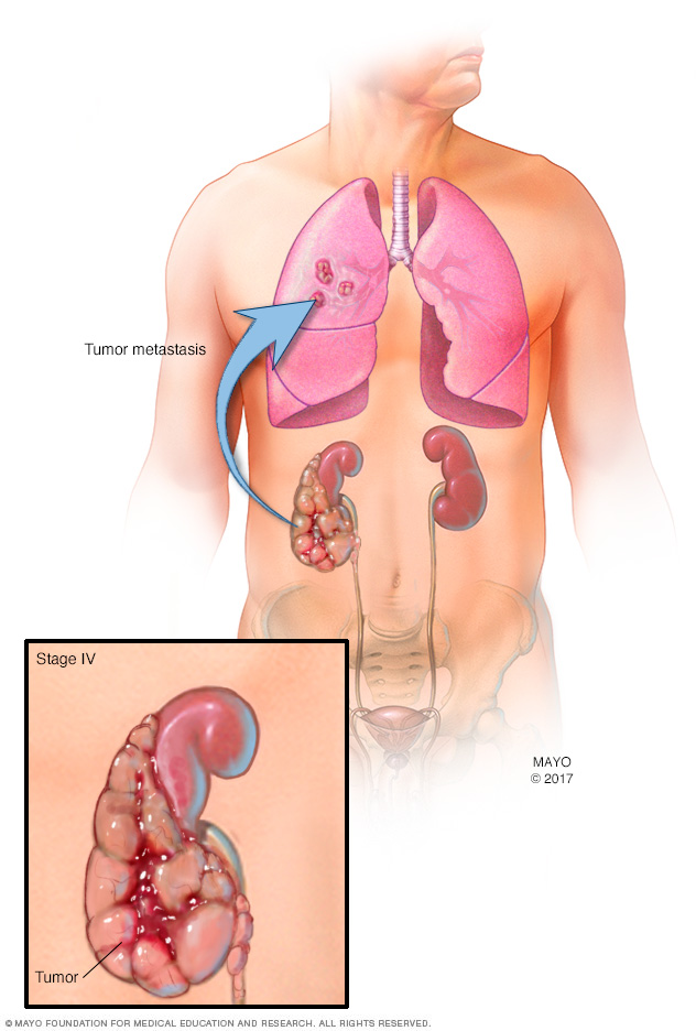 Trin IV nyretumor