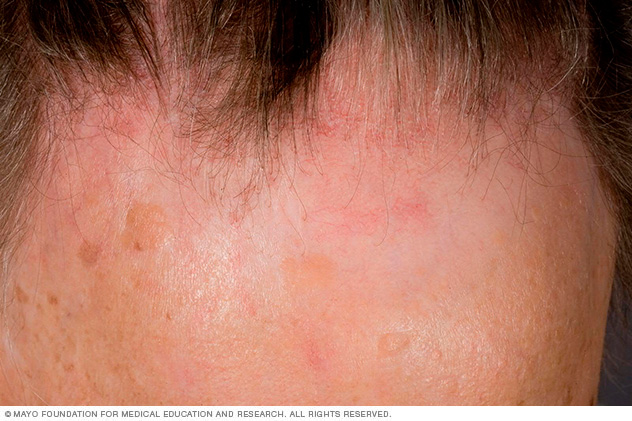 Alopecia fibrosis frontal