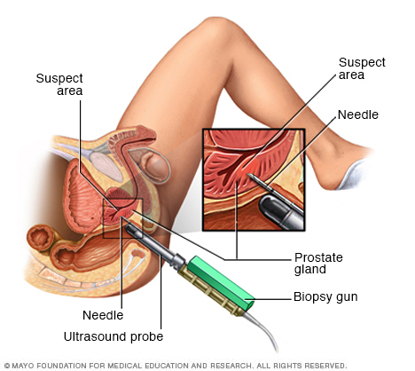 Biopsie transrectale de la prostate