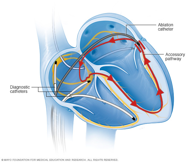 Ablation mit Katheter