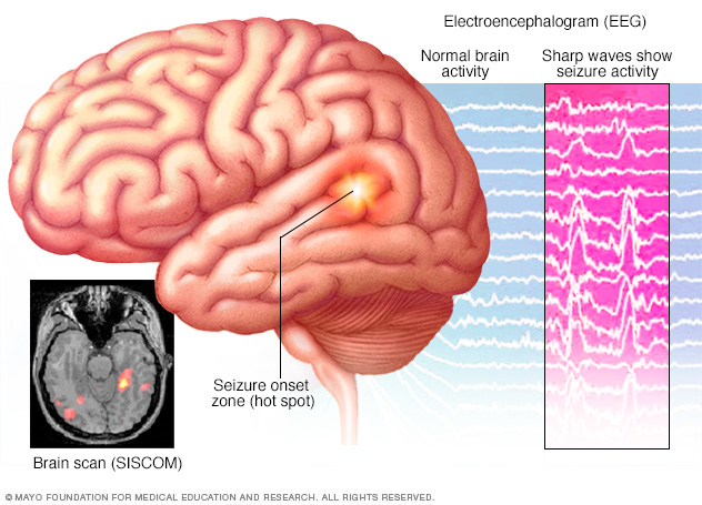 Bagaimana epilepsi didiagnosis? - Dewan Medis