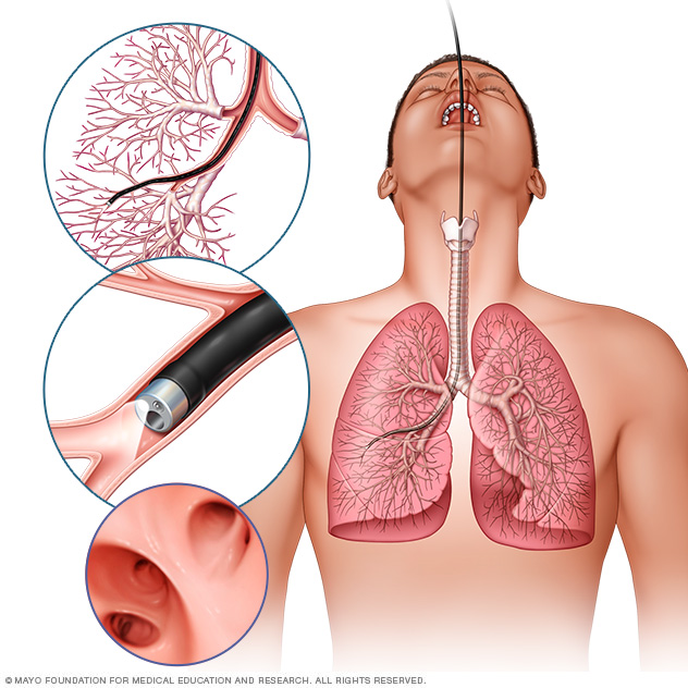 Bronchoscopy
