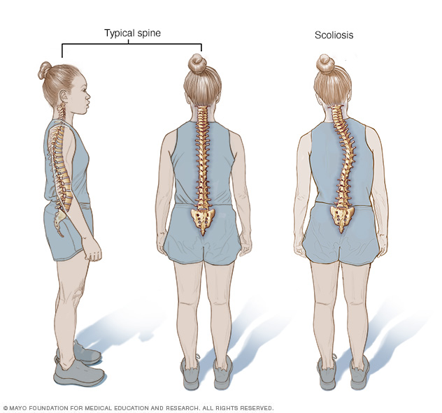 Escoliosis