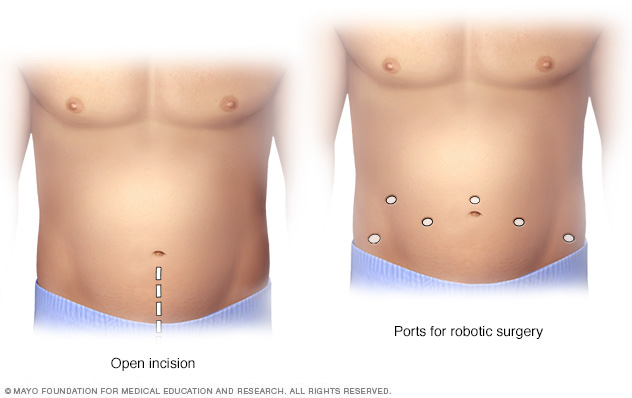 Prostatectomy 