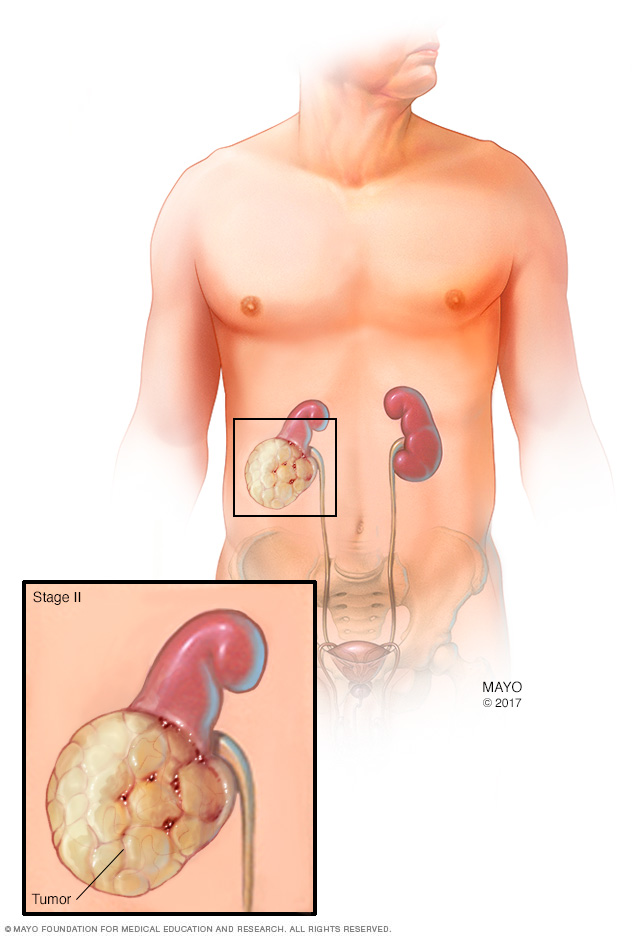 Trin II nyretumor