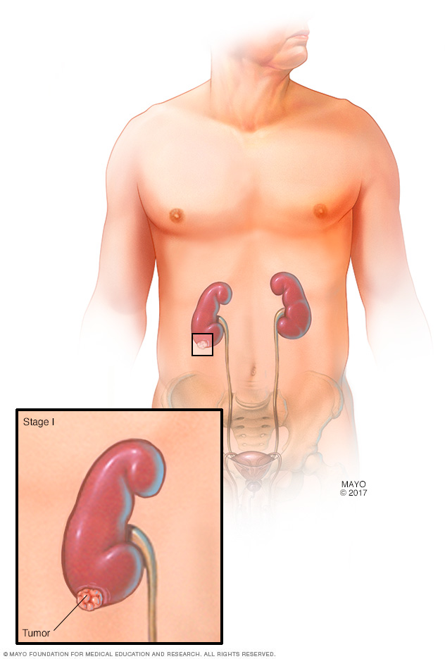 Tumor de riñón en estadio I