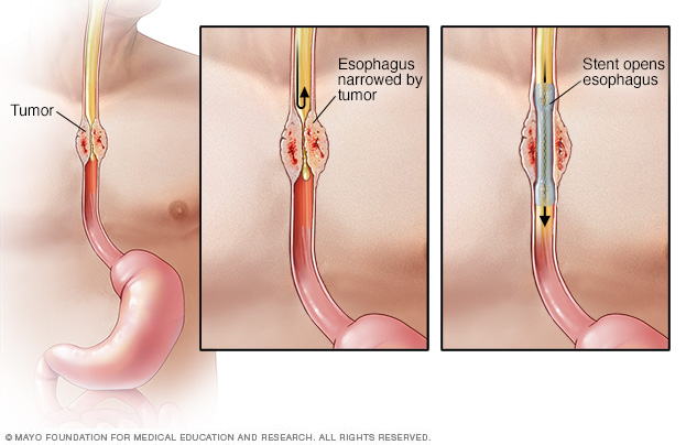 Esophageal Cancer Disease Reference Guide Drugs esophageal-stent-post-procedure-boston-scientific