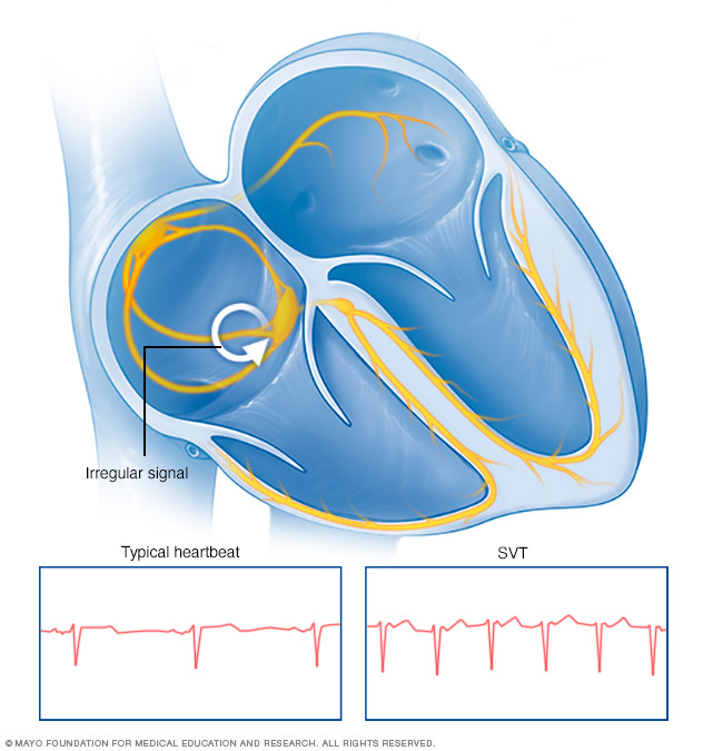 Supraventricular tachycardia Disease Reference Guide 