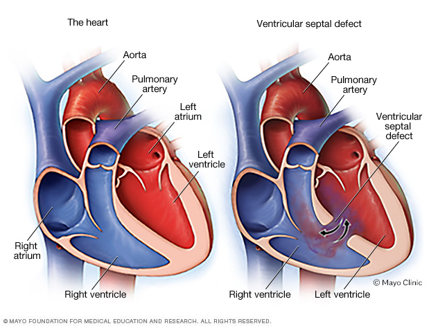 Symptomen en diagnose van ventrikelseptumdefect