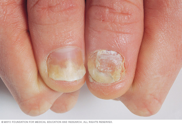 Psoriasis an den Nägeln