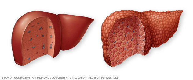 Hígado normal versus cirrosis hepática