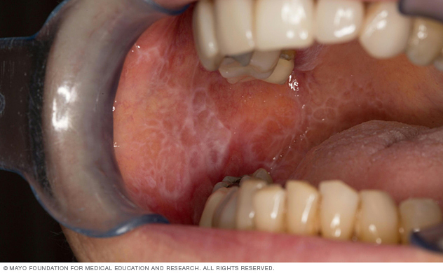 Oral lichen planus