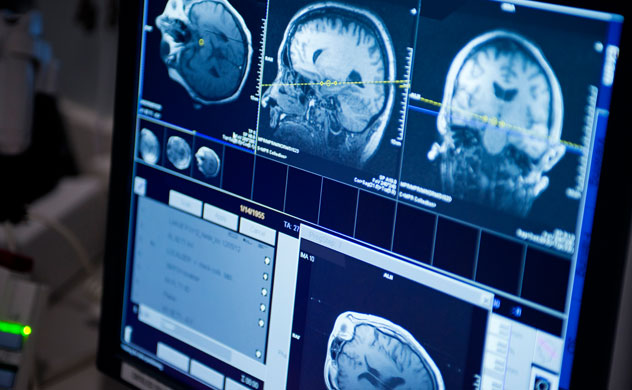 MRI เนื้องอกในสมอง