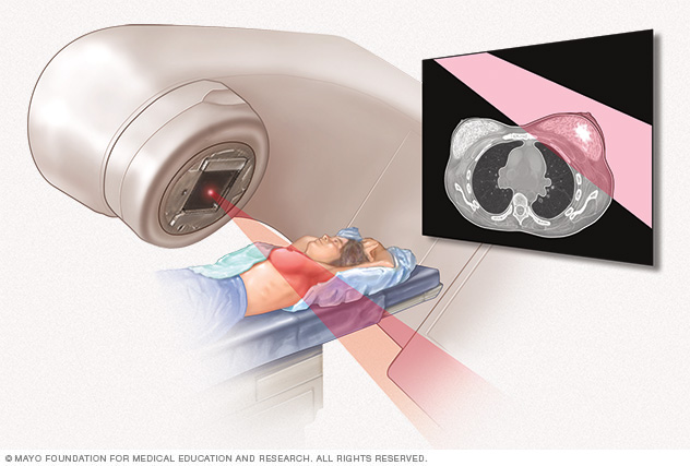 Radioterapia