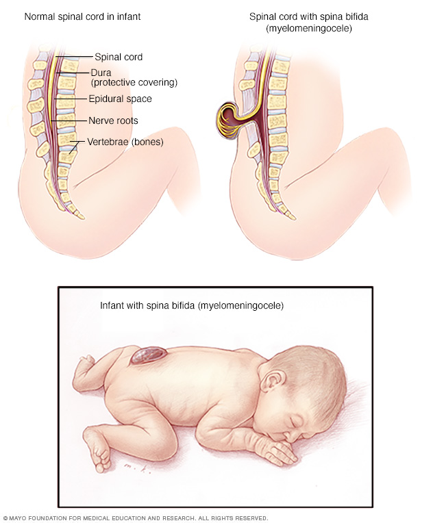 Spina bifida: příčina a příznaky