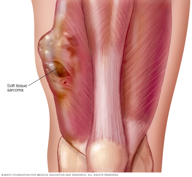 10 Symptoms of sarcoma You Should Never Ignore